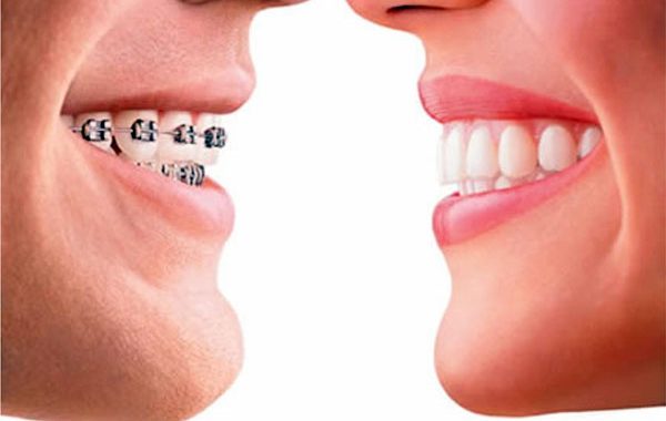 Eğri ve ayrık dişlerin tedavisi